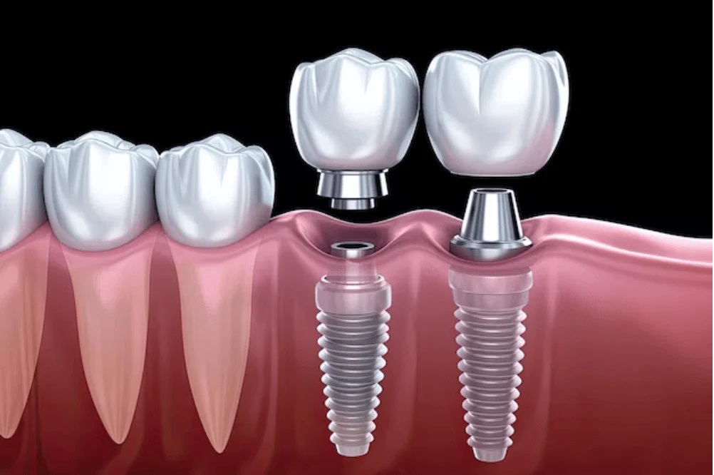 Dentist Supports
